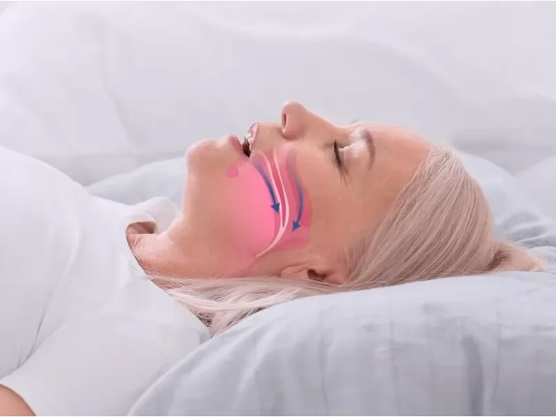 Test STOP-BANG para detectar el síndrome de apnea del sueño en adultos